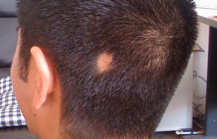 alopecie